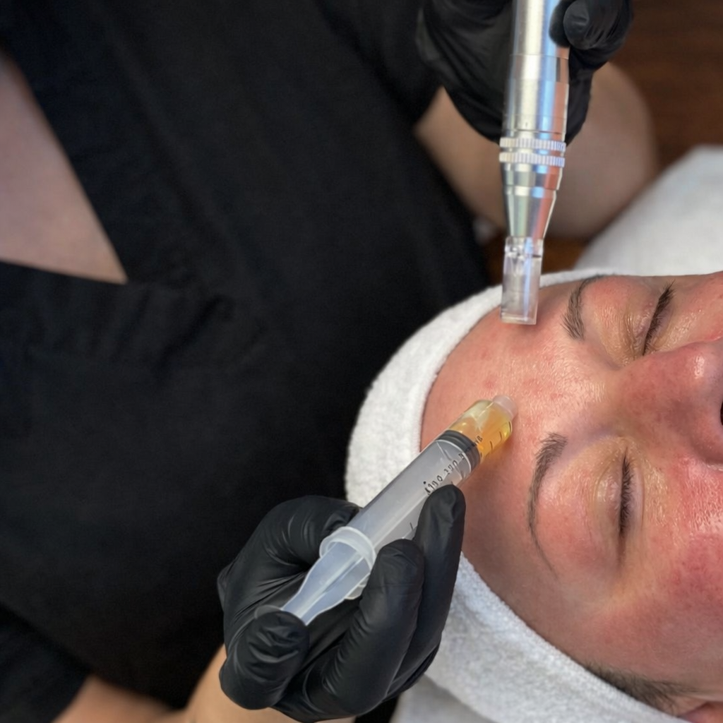 PRP Skin Rejuvenation Treatment